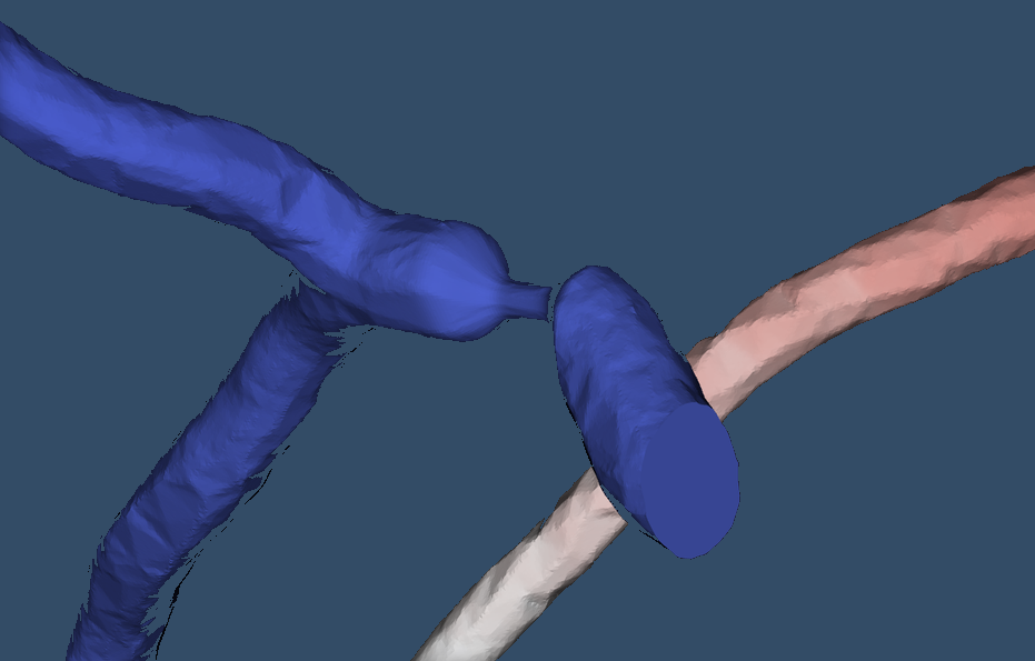 Coronary Bypass Graft